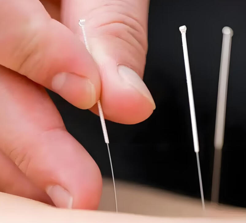 Acupuncture